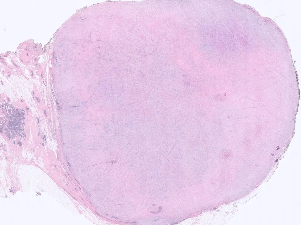 Metaplastic Carcinoma, Spindle Cell Type 