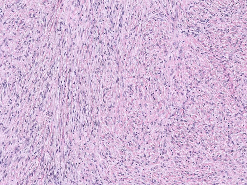 Metaplastic Carcinoma, Spindle Cell Type 
