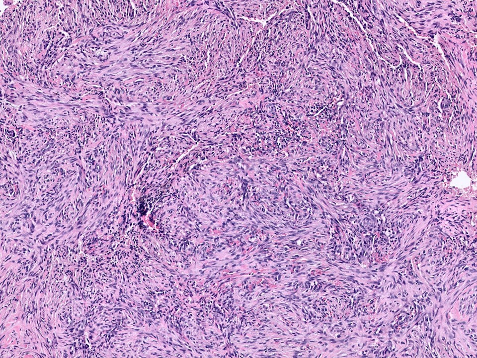 Low Grade Fibromatosis-Like Metaplastic Carcinoma 