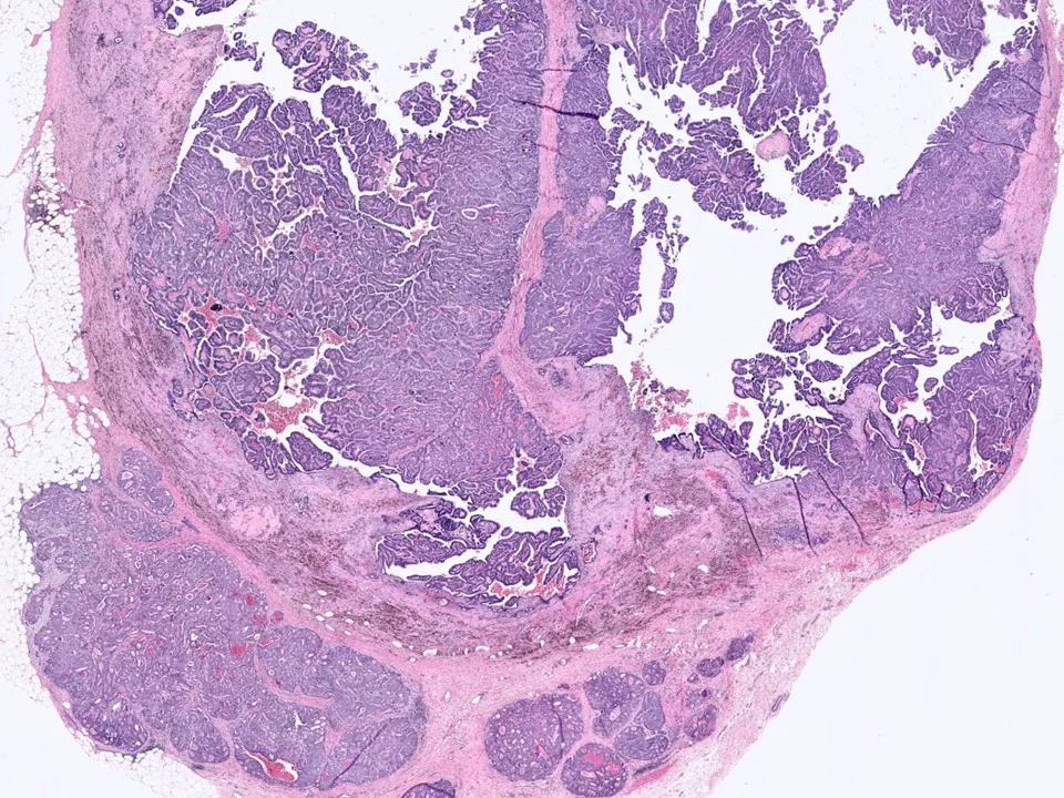 Encapsulated Papillary Carcinoma, With Adjacent Invasive Ductal Carcinoma