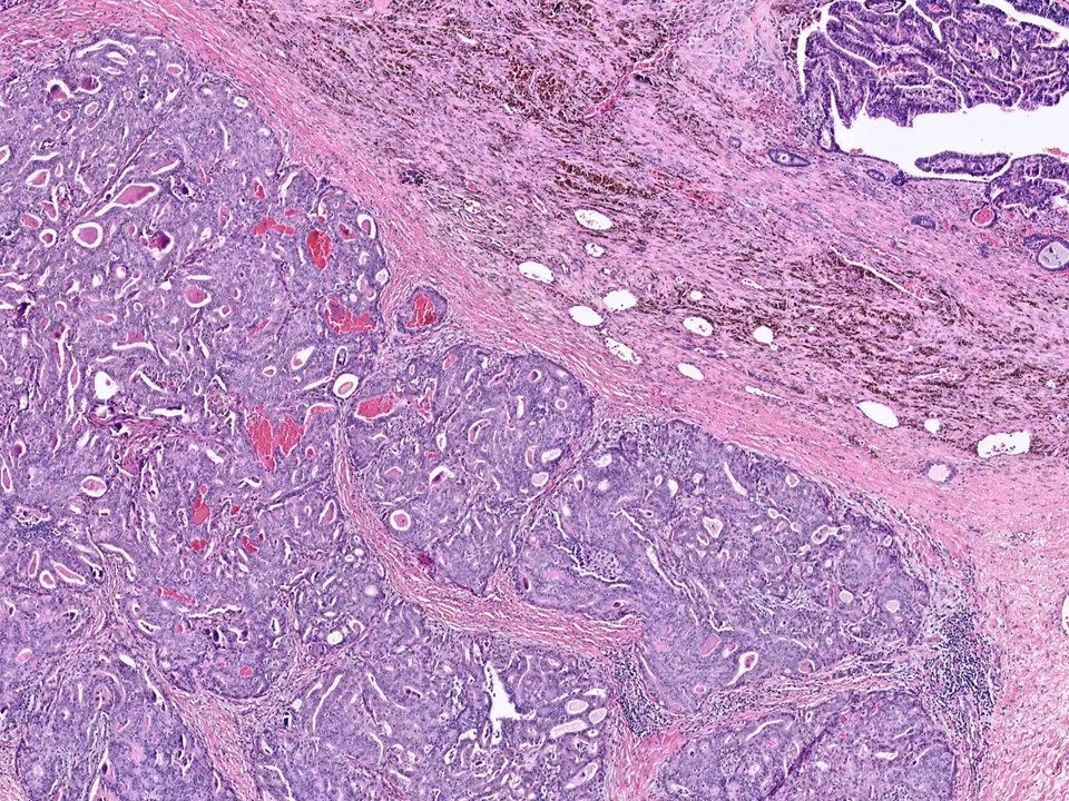 Encapsulated Papillary Carcinoma, With Adjacent Invasive Ductal Carcinoma
