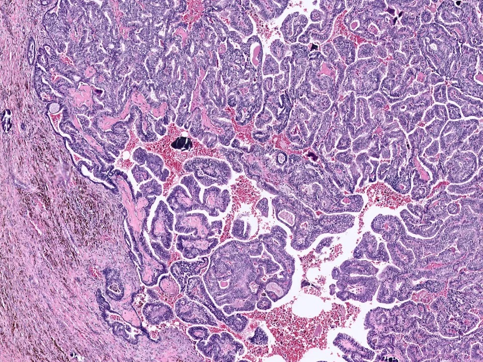 Encapsulated Papillary Carcinoma