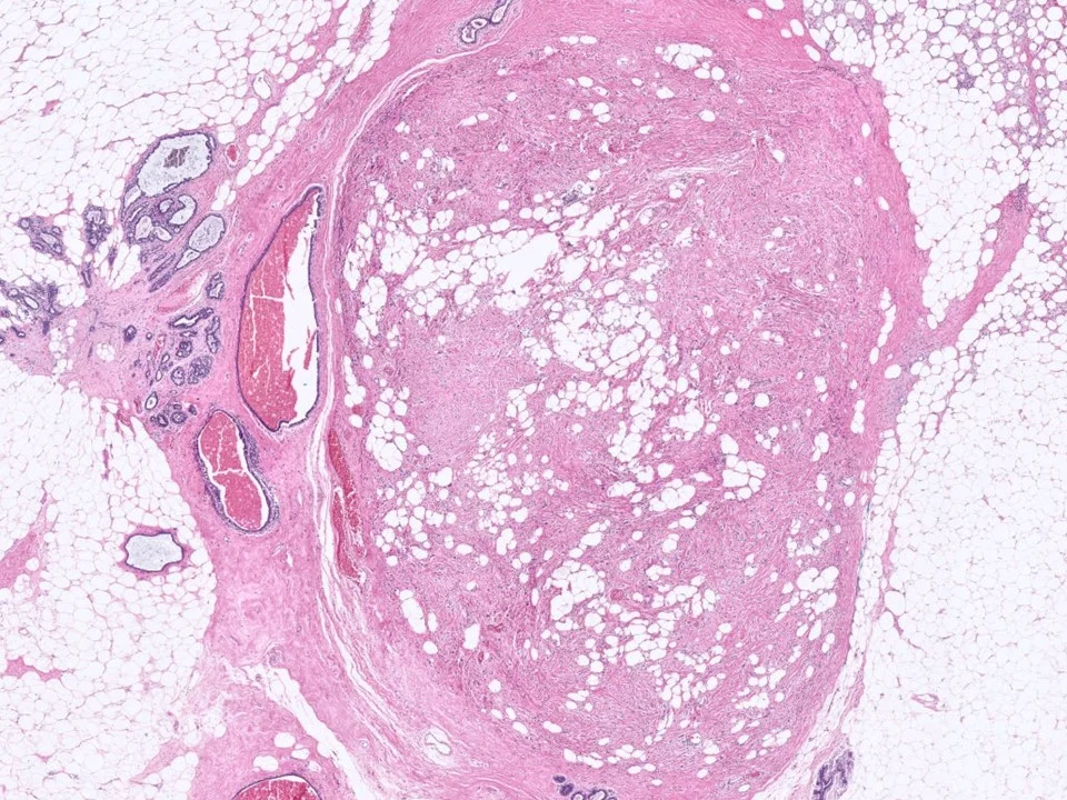 Myofibroblastoma, With Marked Nuclear Atypia
