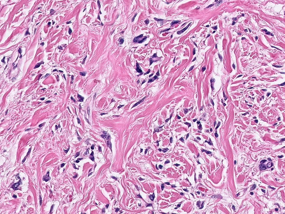 Myofibroblastoma, With Marked Nuclear Atypia