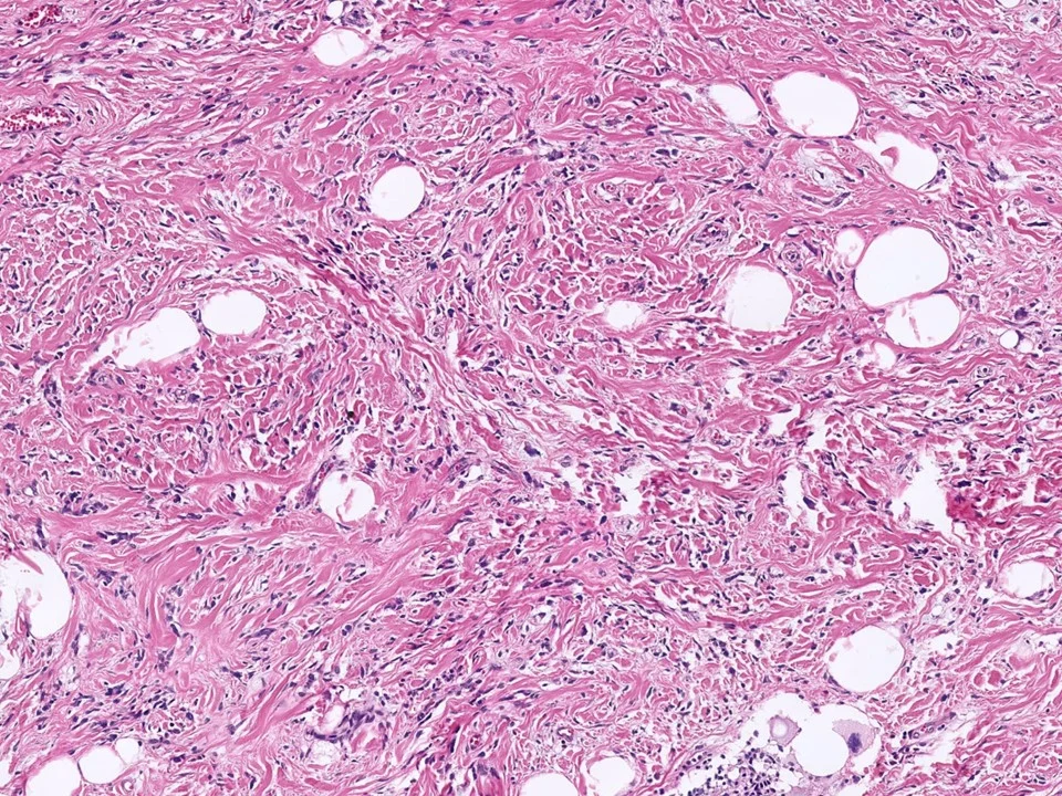 Myofibroblastoma, With Marked Nuclear Atypia