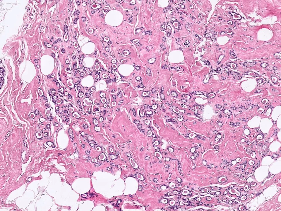 Microglandular Adenosis