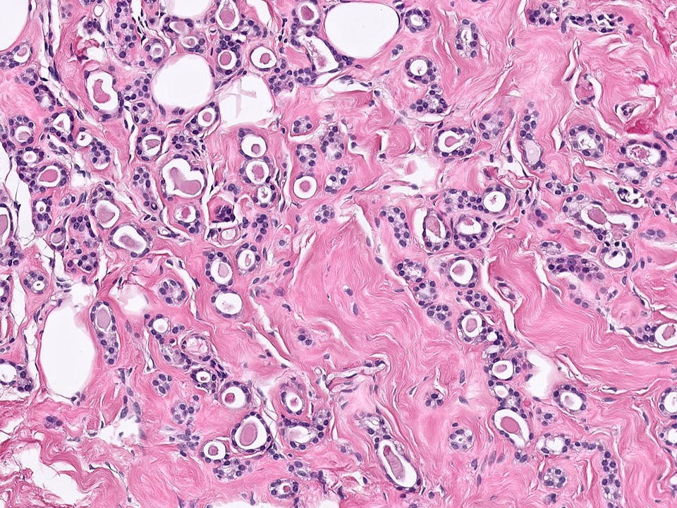 Microglandular Adenosis