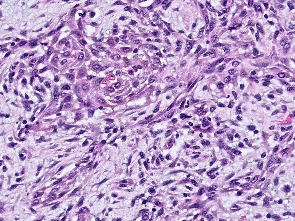 Metaplastic Carcinoma, Spindle Cell Type, With Squamous Areas