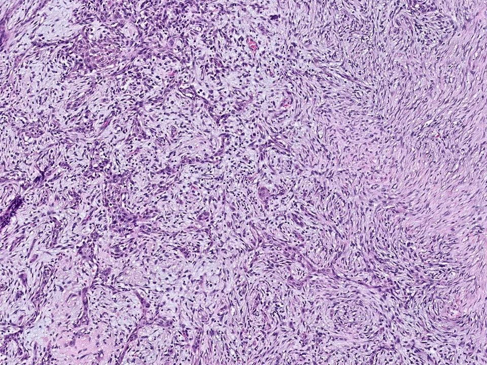 Metaplastic Carcinoma, Spindle Cell Type, With Squamous Areas