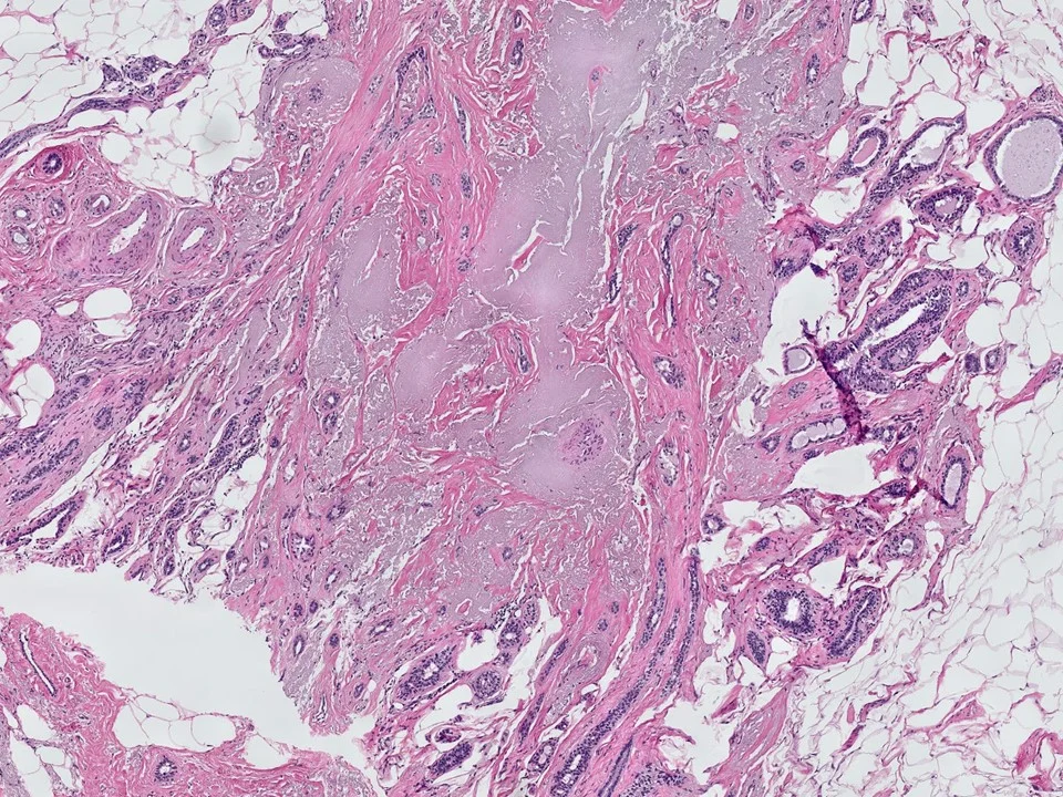 Complex Sclerosing Lesion