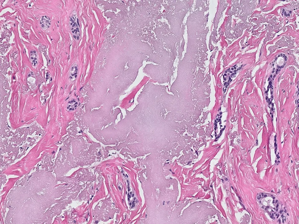 Complex Sclerosing Lesion
