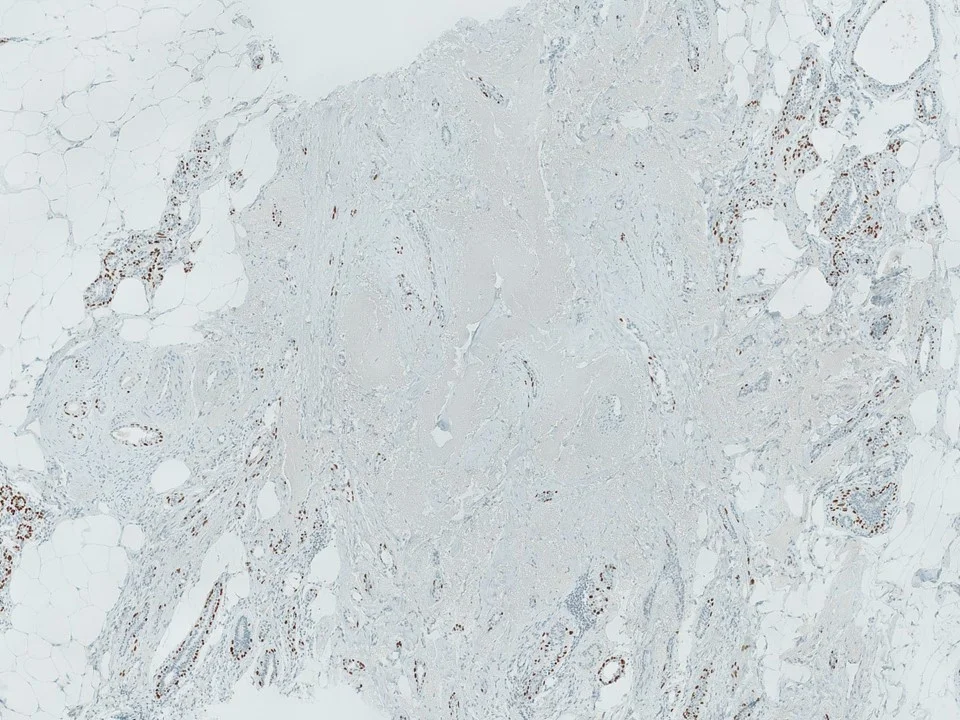 Complex Sclerosing Lesion, p63