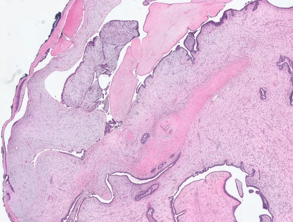 Malignant Phyllodes Tumor