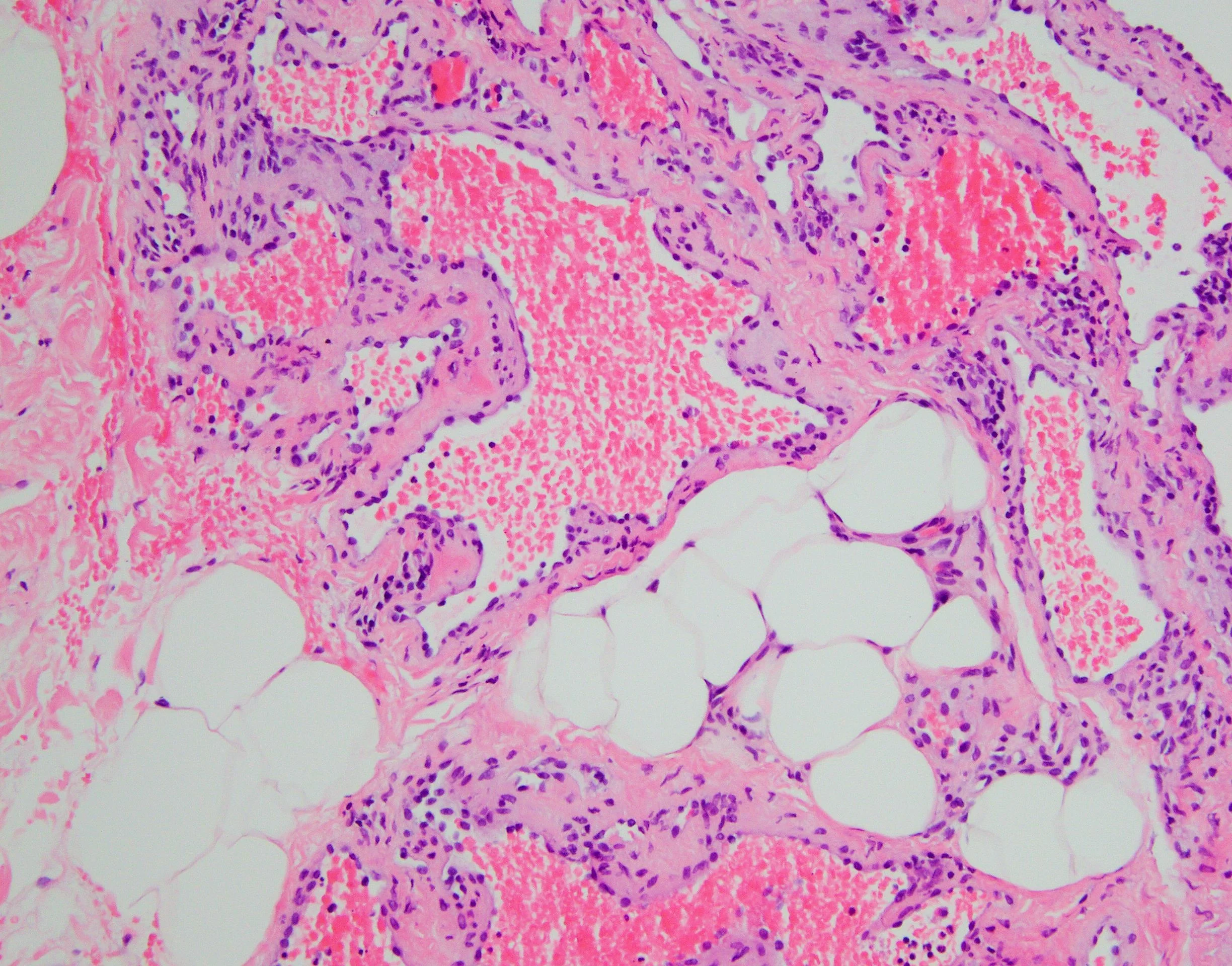 Hemangioma