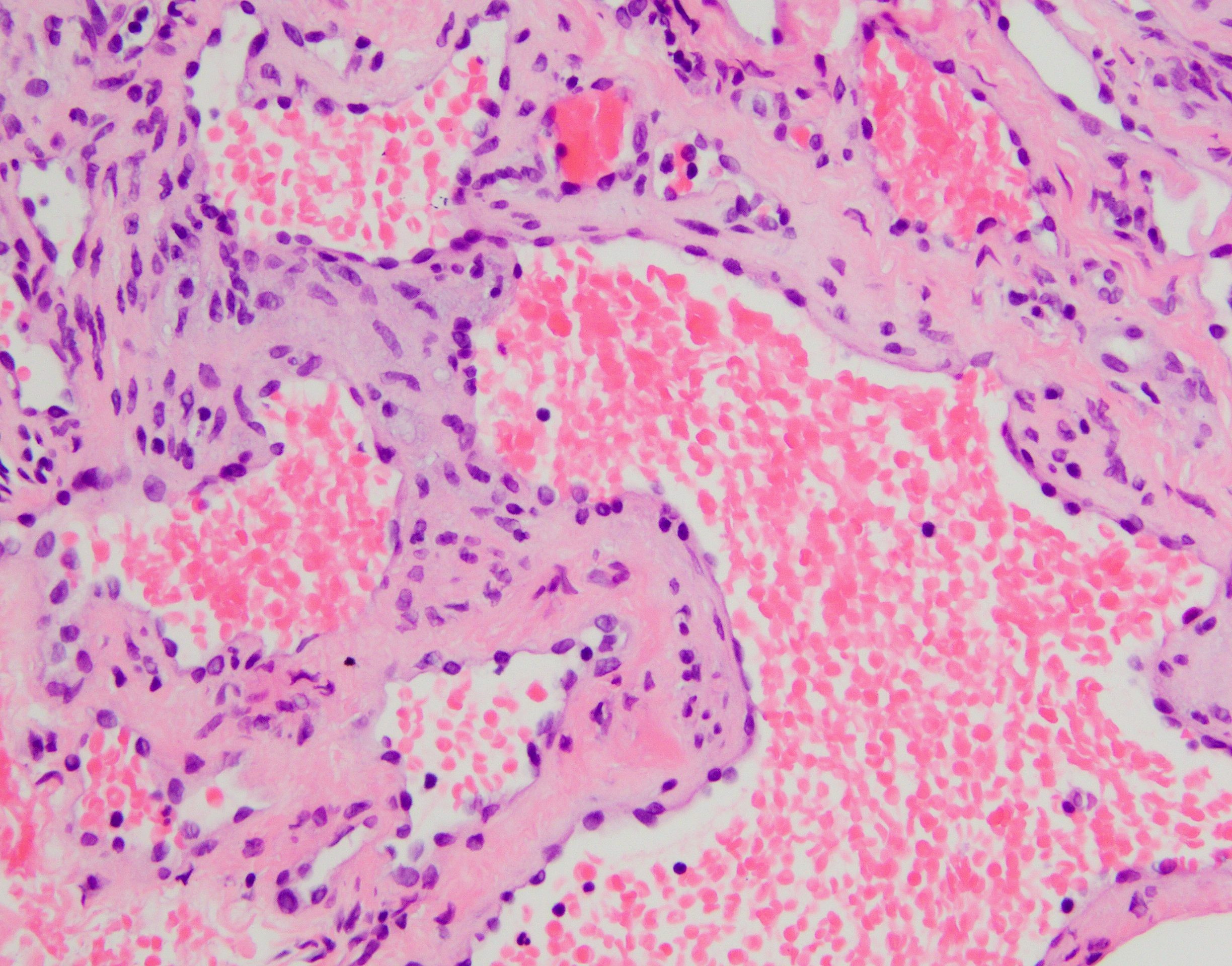 Hemangioma