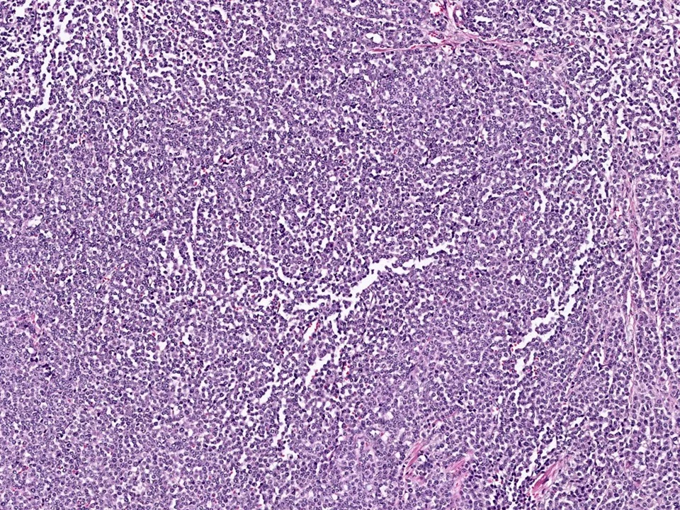 Invasive Lobular Carcinoma, Solid Variant