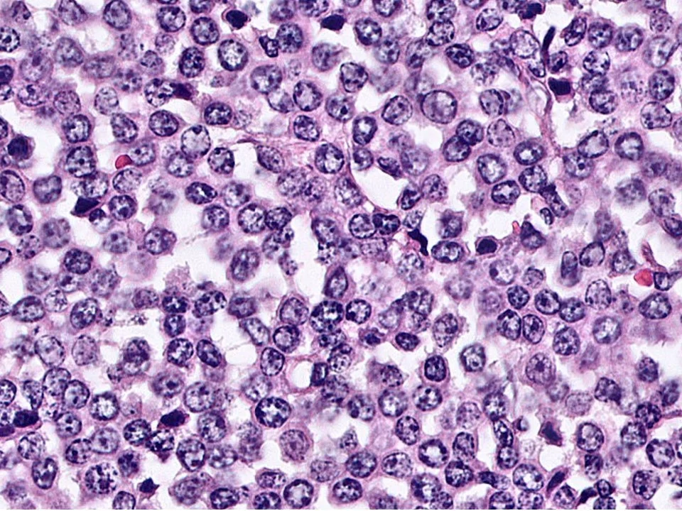 Invasive Lobular Carcinoma, Solid Variant