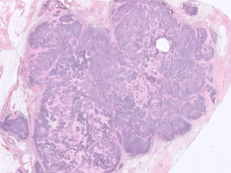 Invasive Lobular Carcinoma, Solid Variant