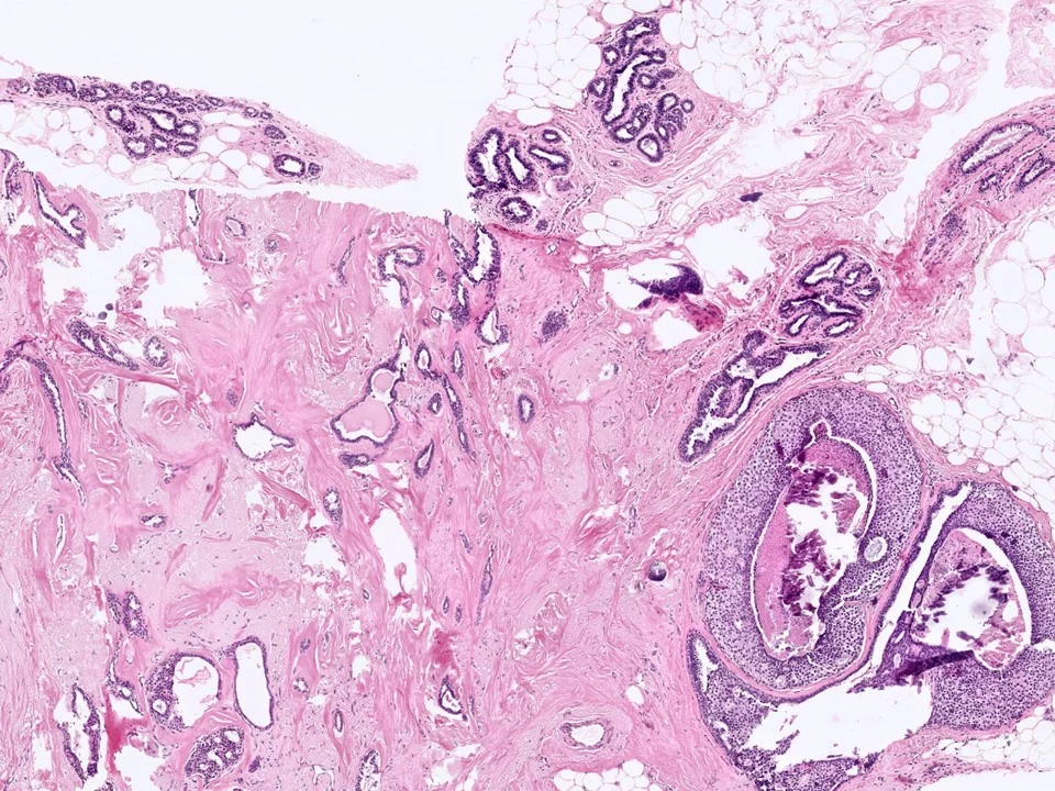 Radial Scar, With Involvement by DCIS