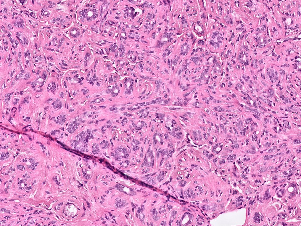 Sclerosing Adenosis