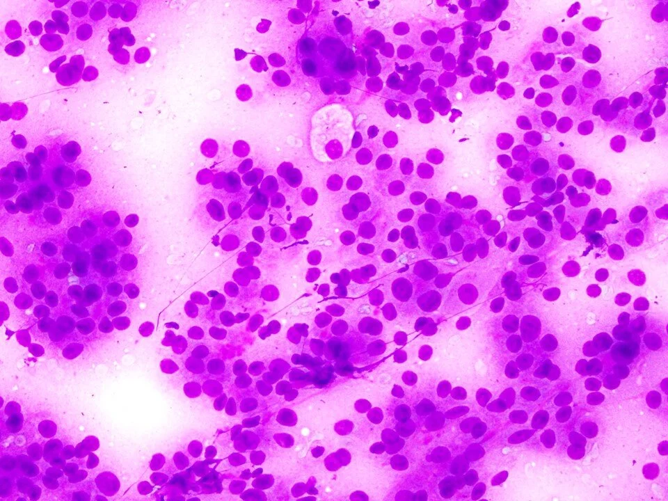 Sclerosing pneumocytoma