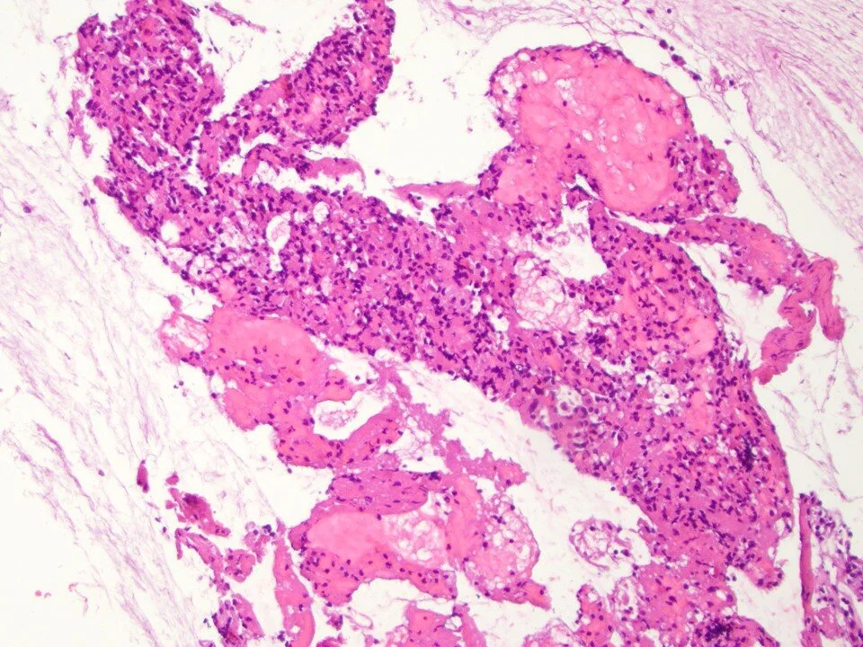 Sclerosing pneumocytoma - cell block