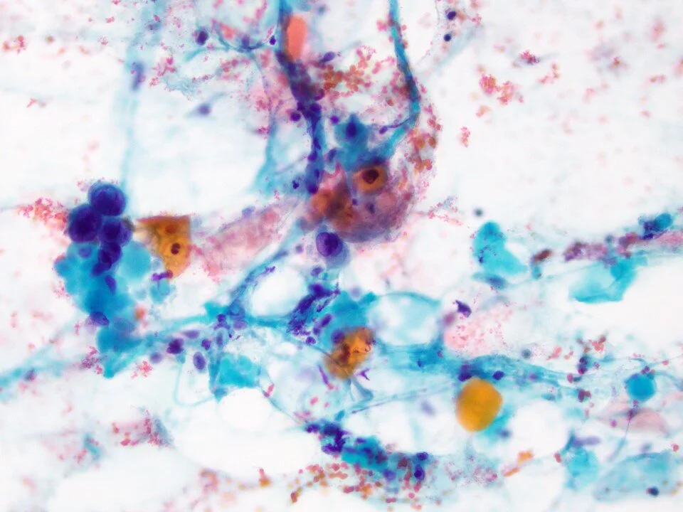 Squamous cell carcinoma, keratinizing type