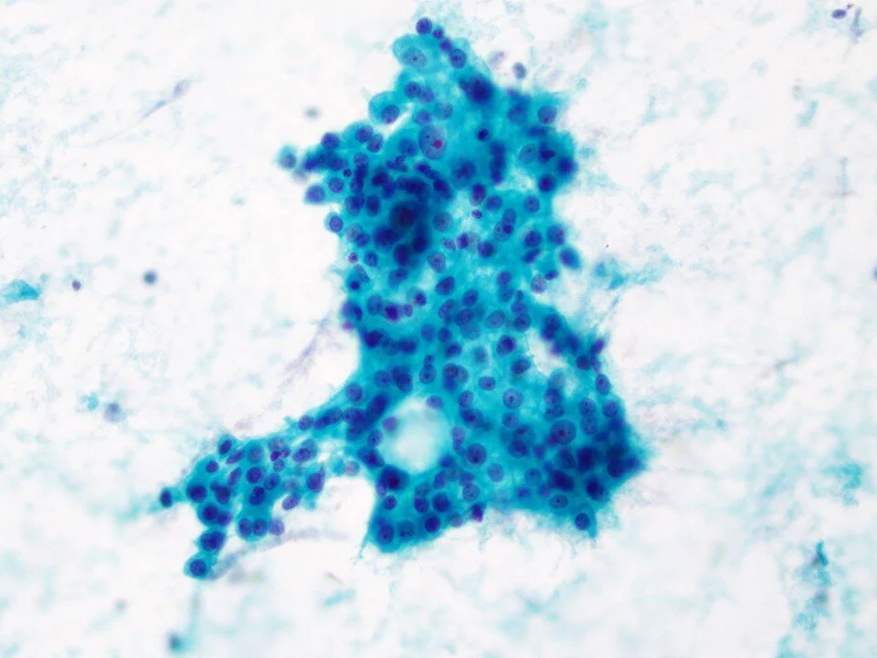 Adenocarcinoma
