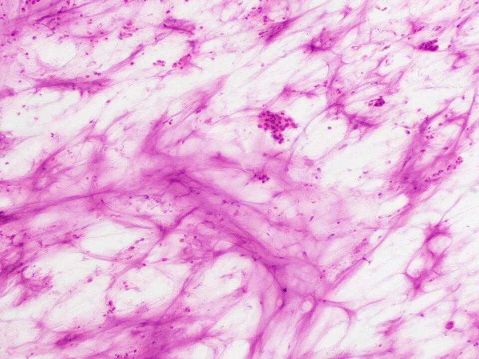 Well-differentiated mucinous adenocarcinoma