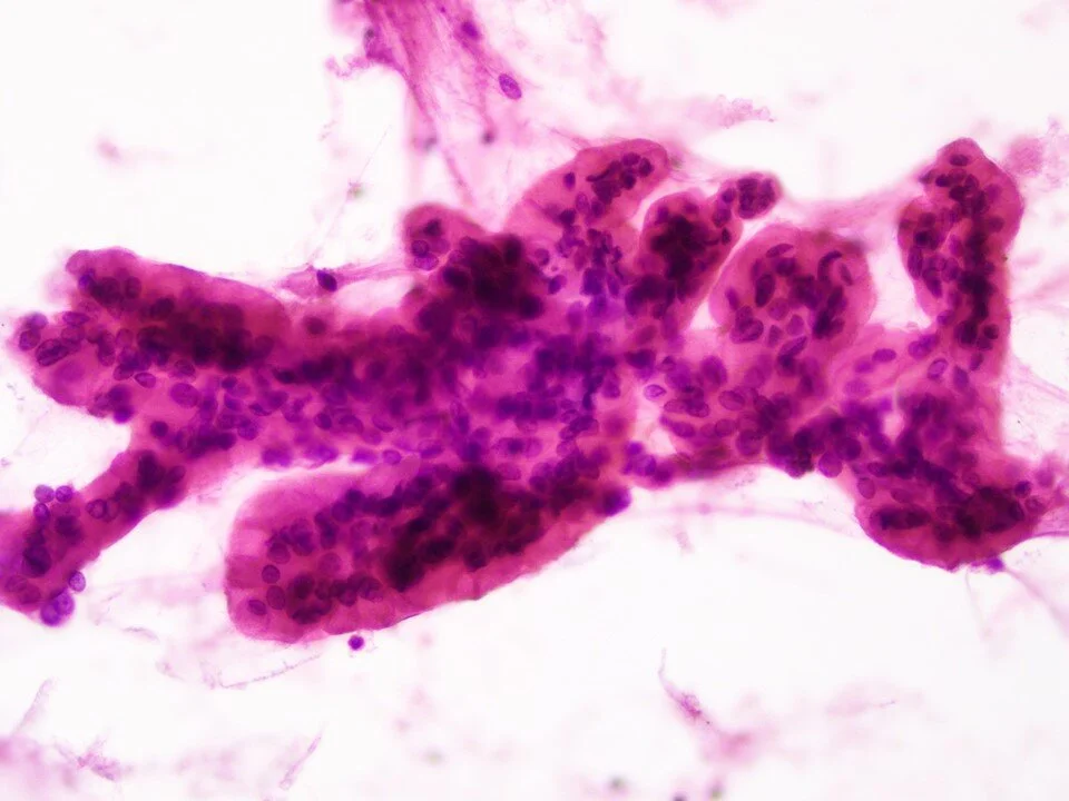 Well-differentiated mucinous adenocarcinoma