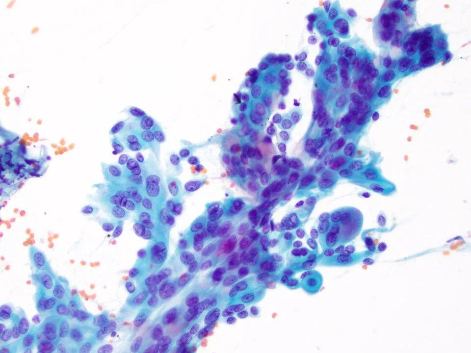 Well-differentiated mucinous adenocarcinoma