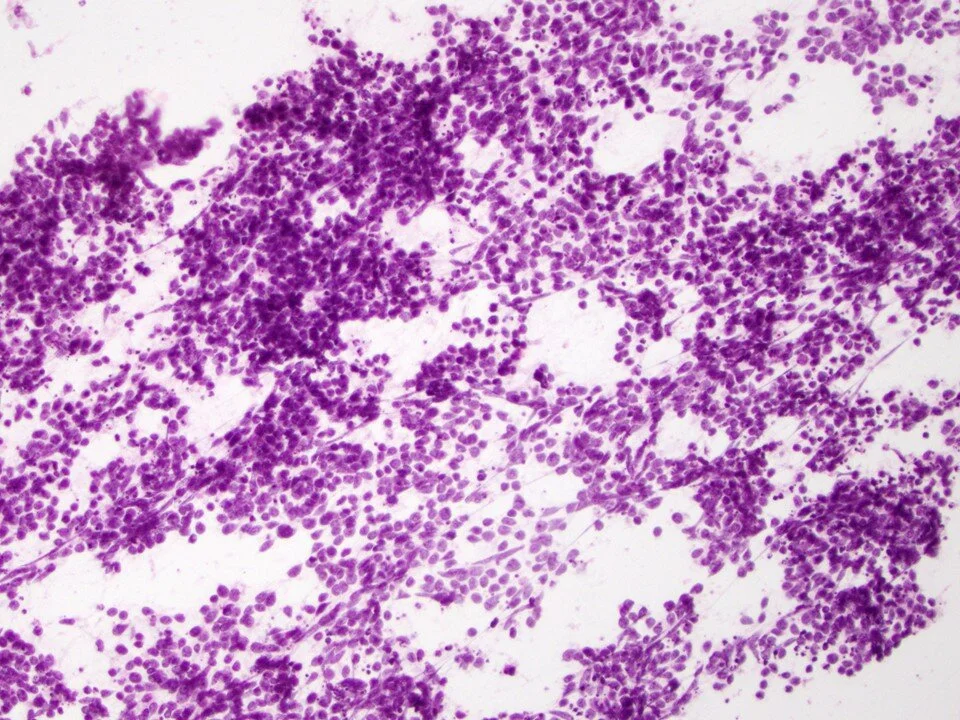 Small cell carcinoma