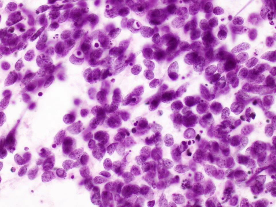 Small cell carcinoma