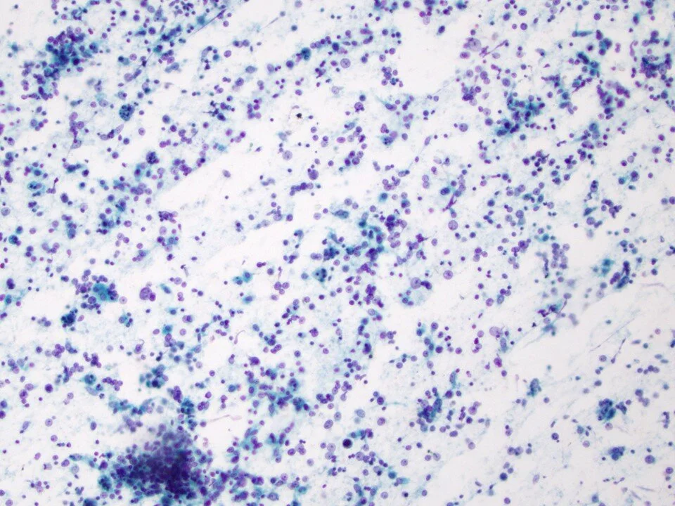 Diffuse large B cell lymphoma