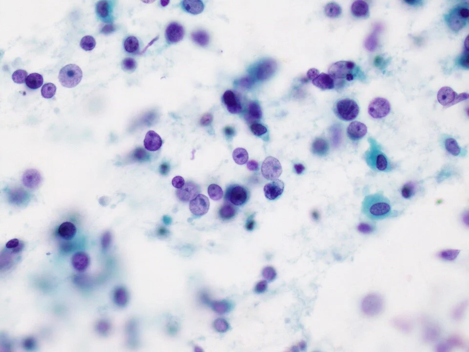 Diffuse large B cell lymphoma