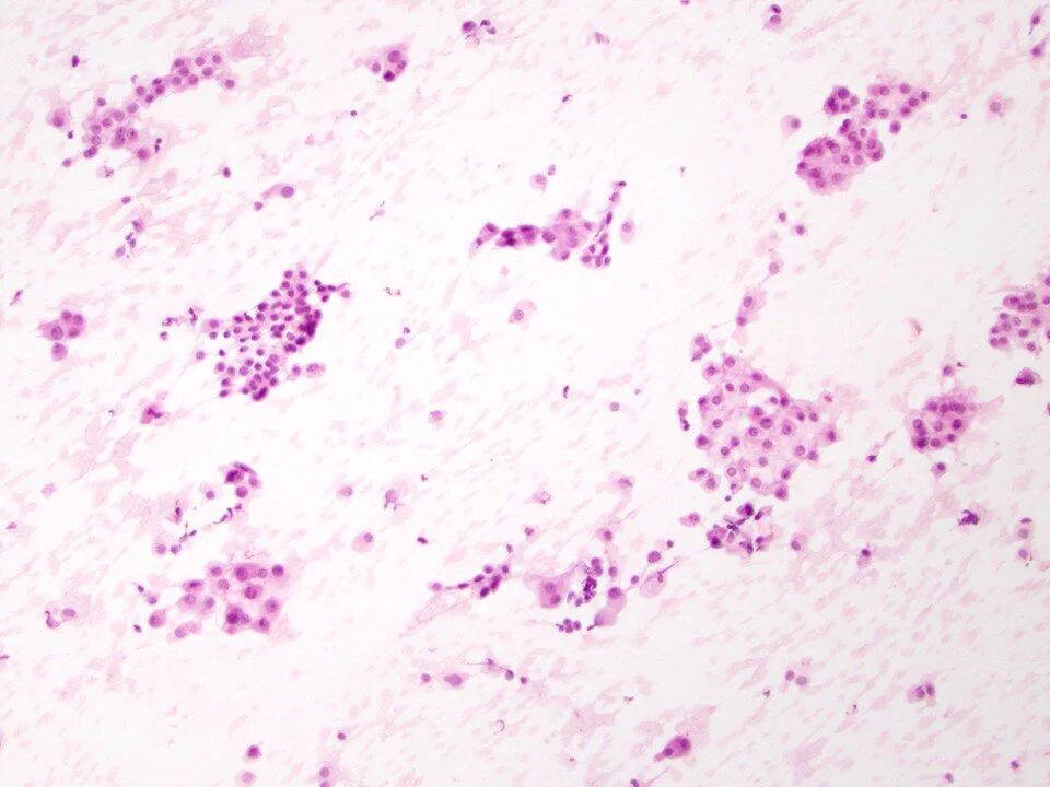 Mesothelioma