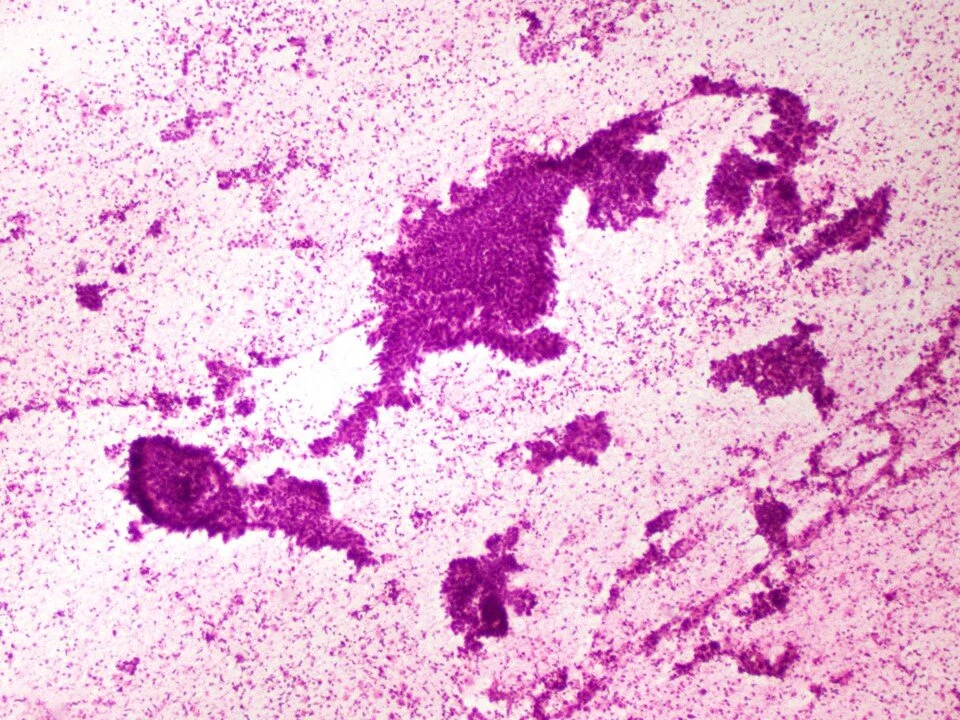 Metastatic colorectal carcinoma