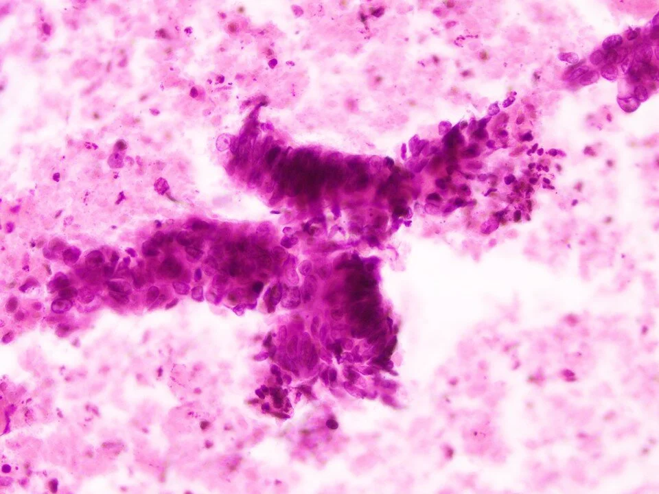 Metastatic colorectal carcinoma