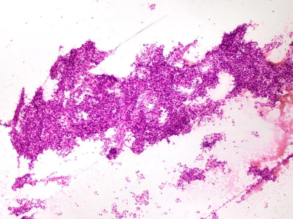 Metastatic clear cell renal cell carcinoma