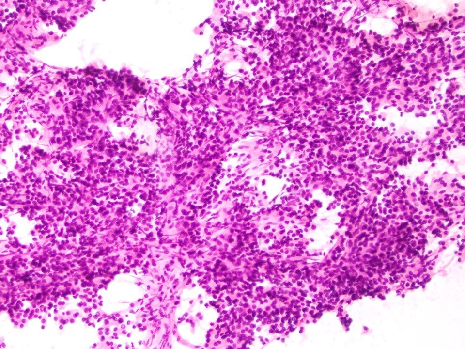 Metastatic clear cell renal cell carcinoma