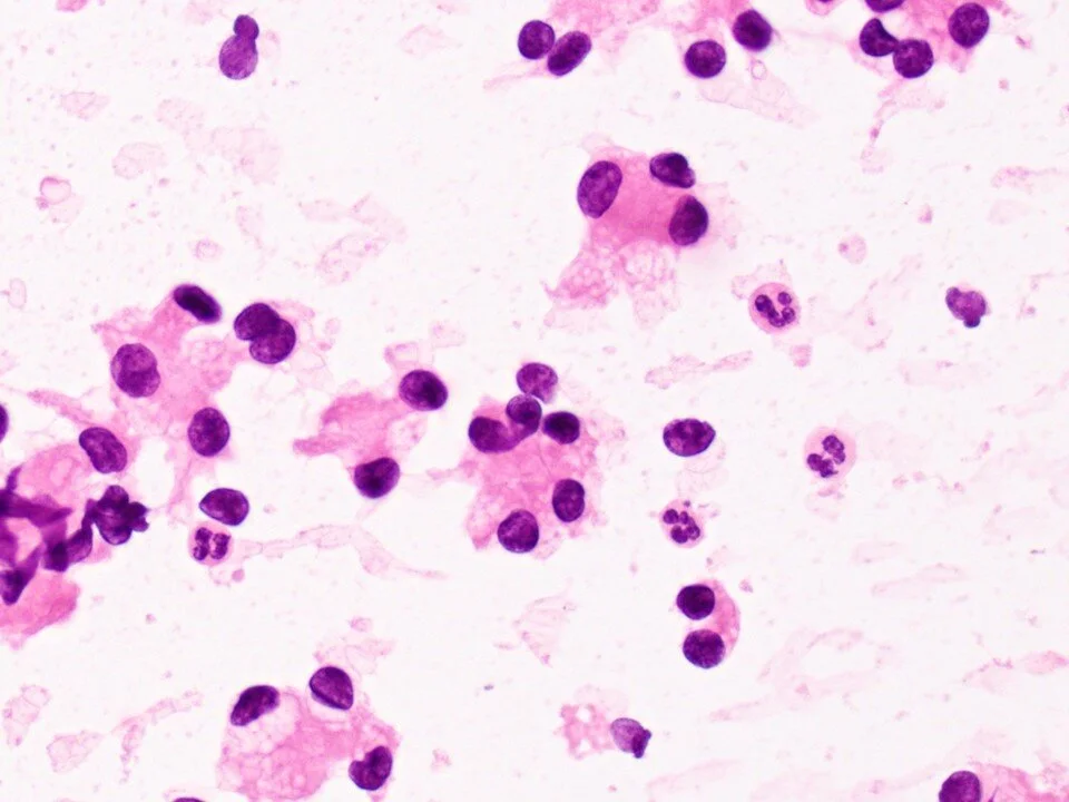 Metastatic clear cell renal cell carcinoma