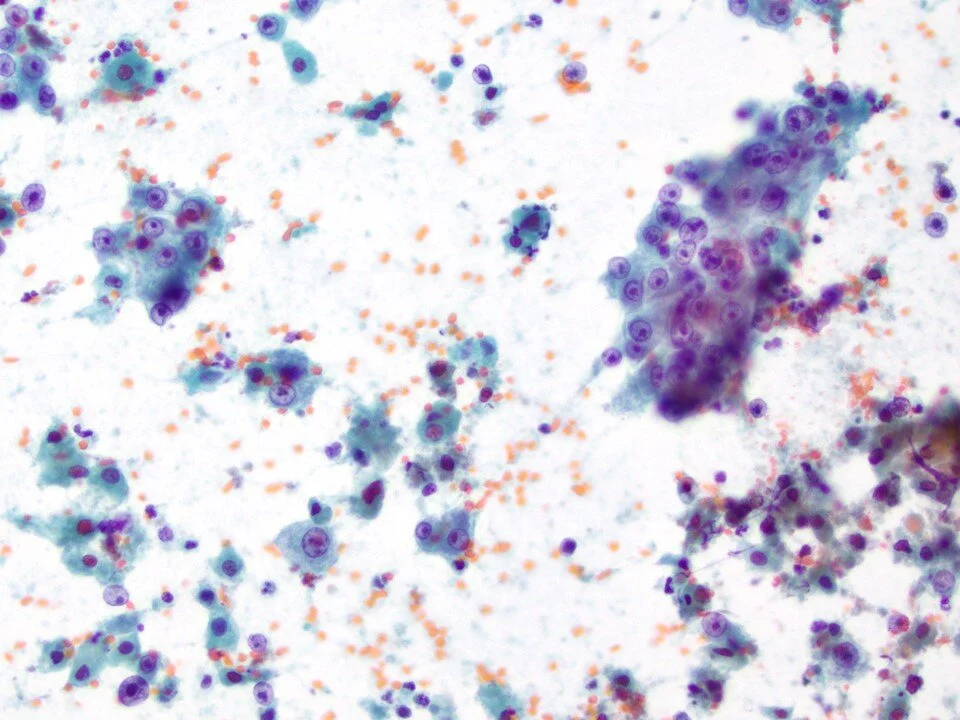 Metastatic hepatocellular carcinoma