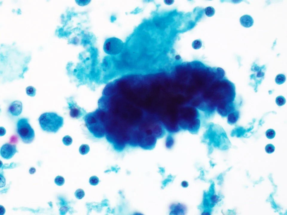 Reactive bronchial cells