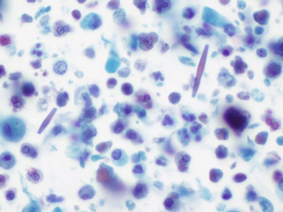 Charcot-Leyden Crystals