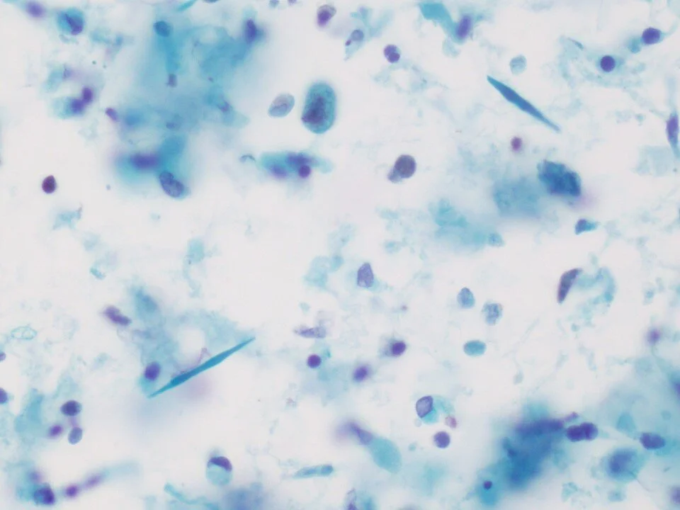 Charcot-Leyden Crystals