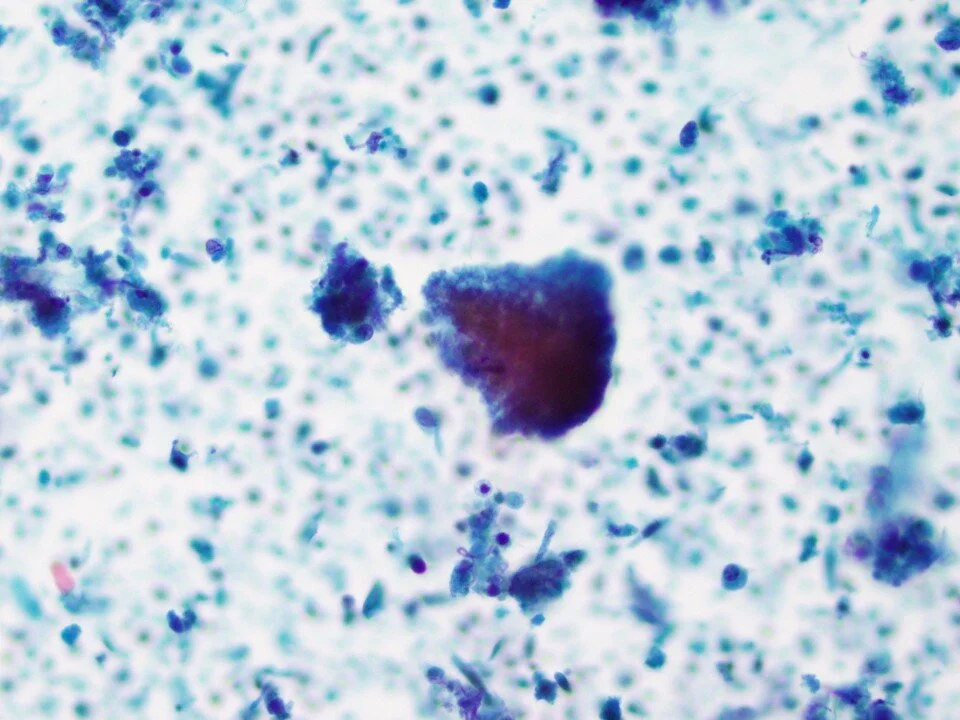 Pneumocystis jirovecii