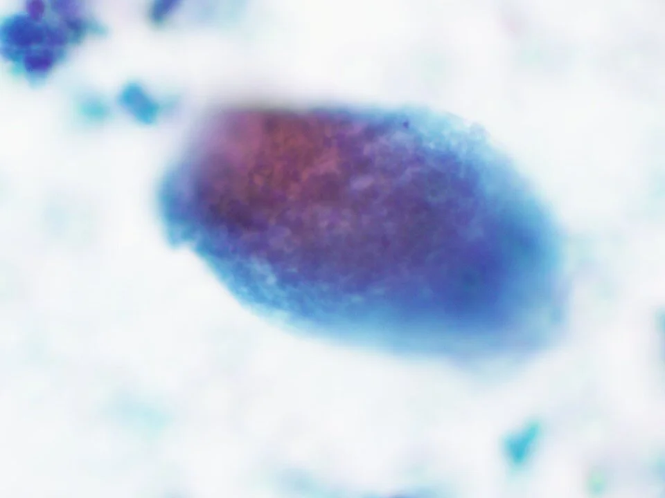 Pneumocystis jirovecii