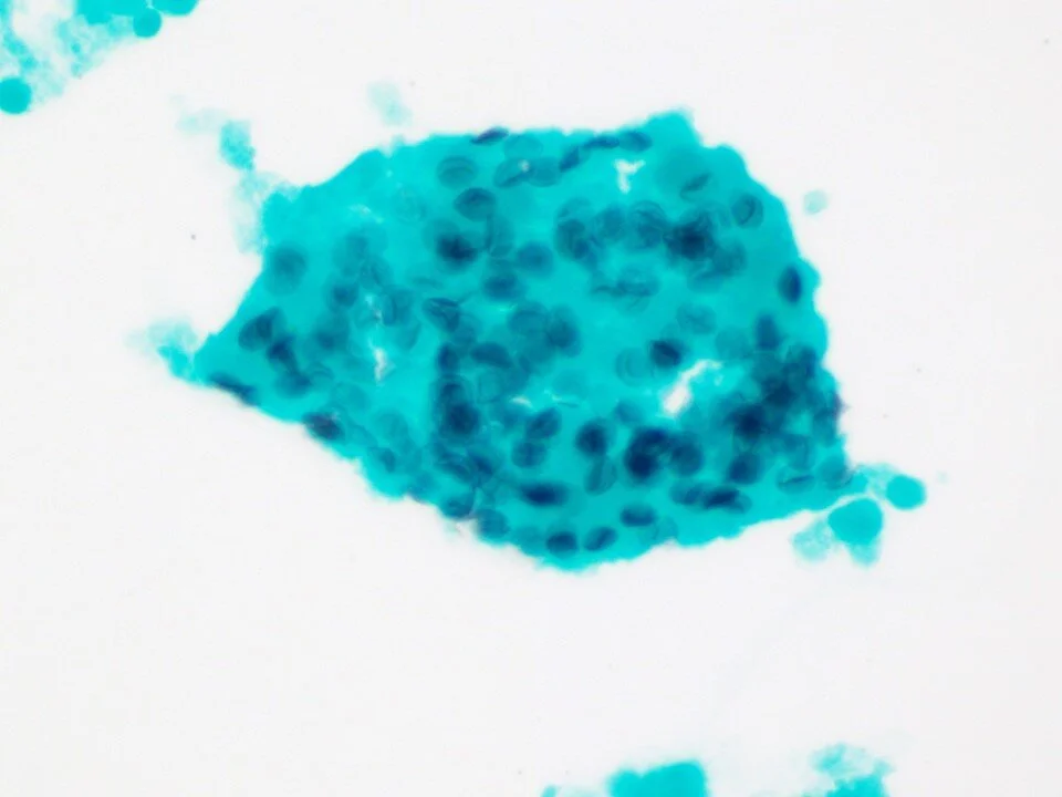 Pneumocystis jirovecii