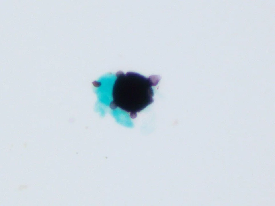 Paracoccidioidomycosis