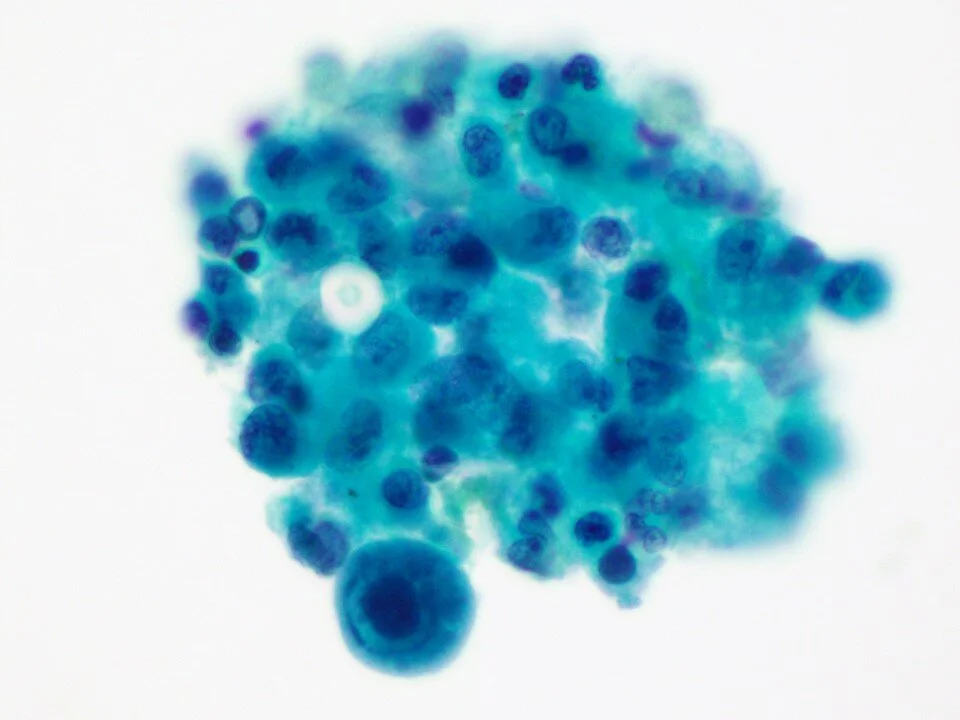Cytomegalovirus